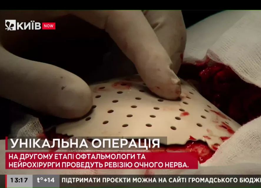 Exclusive interview from Ukraine:the 1st cranioplasty case with PEEK
