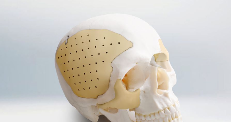 Recranio? Cranio-Maxillofacial repair system